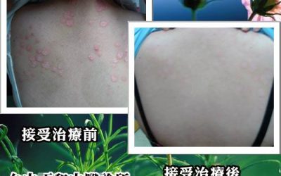 6、7年級生乾癬病患漸多
