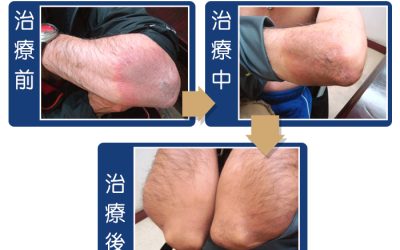 乾癬治療案例二