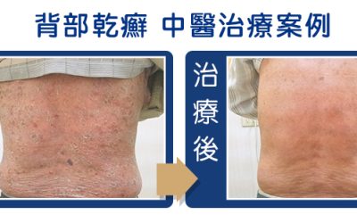 乾癬治療案例三