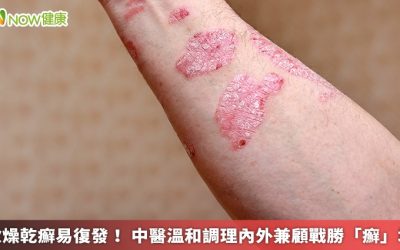 秋燥乾癬易復發! 中醫溫和調理內外兼顧戰勝「癬」境