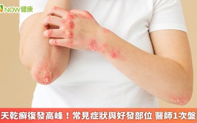 春天乾癬復發高峰!常見症狀與好發部位 醫師1次盤點